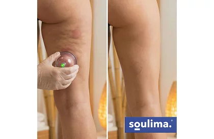 Kínai köpöly készlet tűz nélküli köpölyözéshez – 12 darab